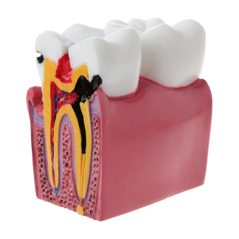 6 раз Сравнение кариеса зубов Анатомическая модель зубов для стоматологической анатомии Лабораторный учебный инструмент